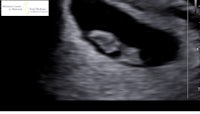 an ultrasound image of a baby's uterus